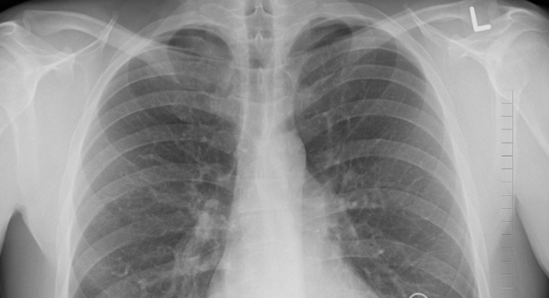 флюорограф, флюорография