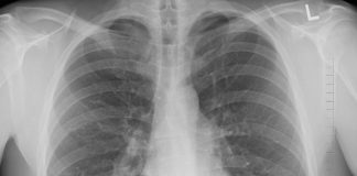 флюорограф, флюорография